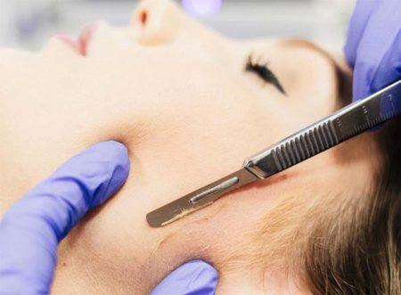 Dermaplaninge151666311581612dcec0b