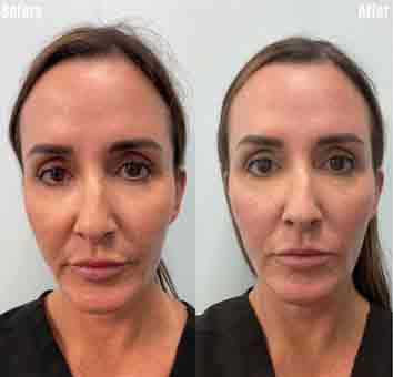 before-after1