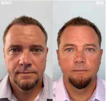 before-after3